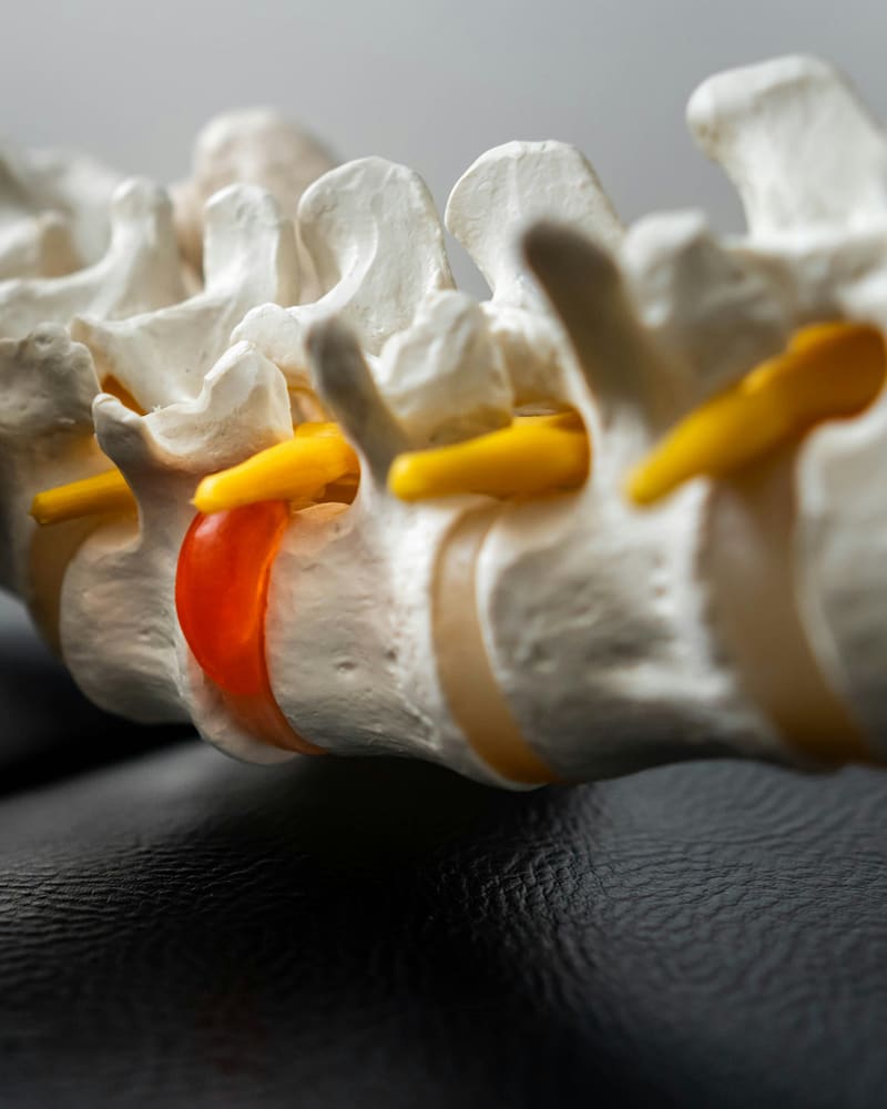 Disc Injuries treatment at IA Chiropractic, Thornlie