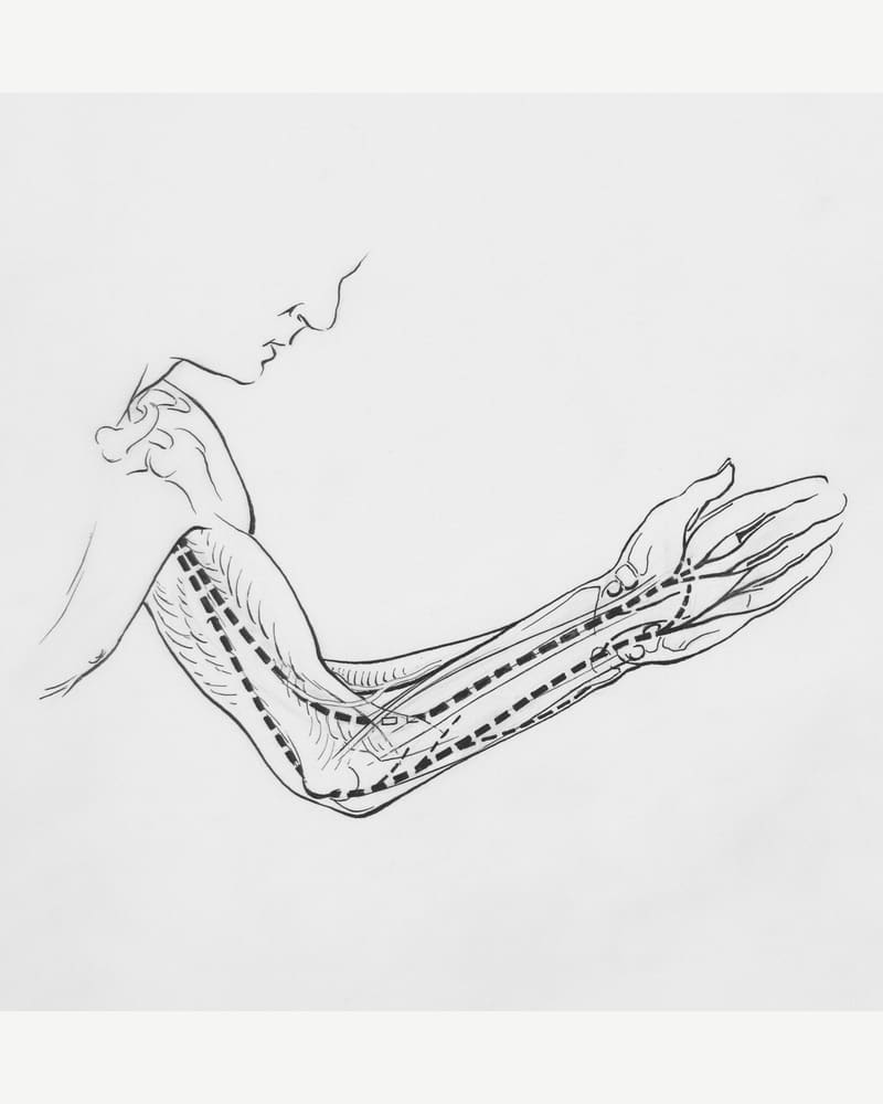 Nerve Pain treatment at IA Chiropractic, Thornlie