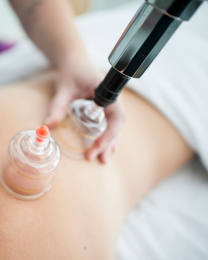 Cupping Therapy at IA Chiropractic, Thornlie